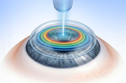 Epi Contoura Flapless LASIK treatment